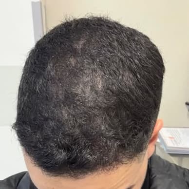 Homem, 26 anos, antes do tratamento capilar